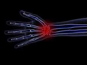 x-ray of hand & wrist with repetitive stress injury
